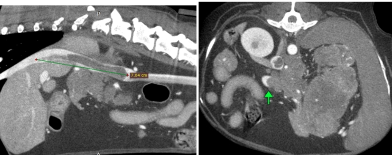 invasive adrenal mass invasive adrenal mass
