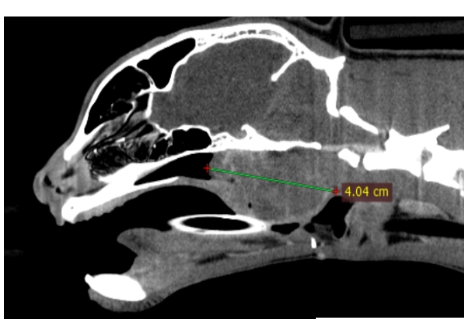 nasopharyngeal lymphoma nasopharyngeal lymphoma