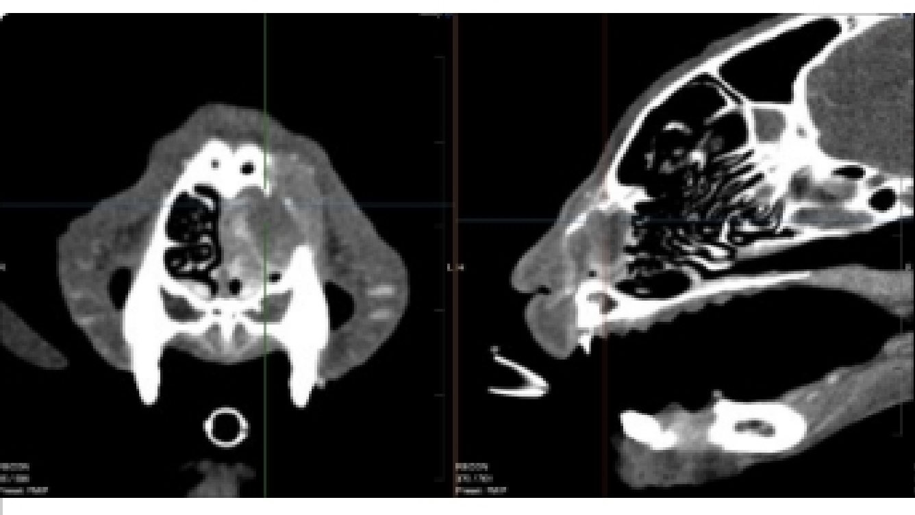 Nasal mass Nasal mass
